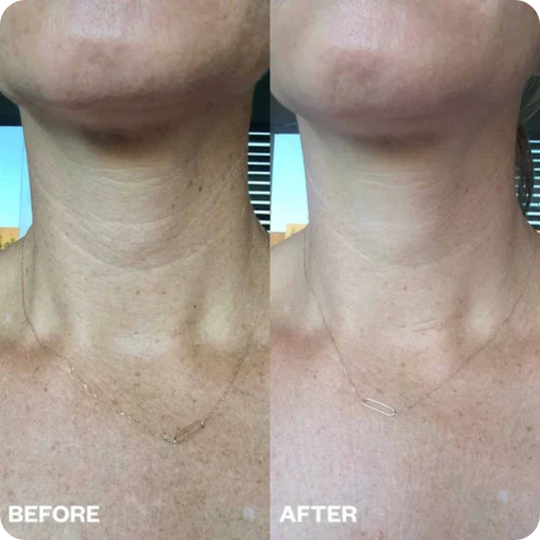 Bio-Collagen Neck Patches